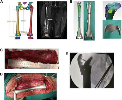 The application of custom 3D-printed prostheses with ultra-short stems in the reconstruction of bone defects: a single center analysis